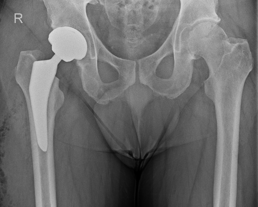 Wer seine Muskeln stärkt, trägt viel dazu bei, dass die Prothese lange hält. Foto: PD Dr. Randau, Augustinerinnen Krankenhäuser gGmbH